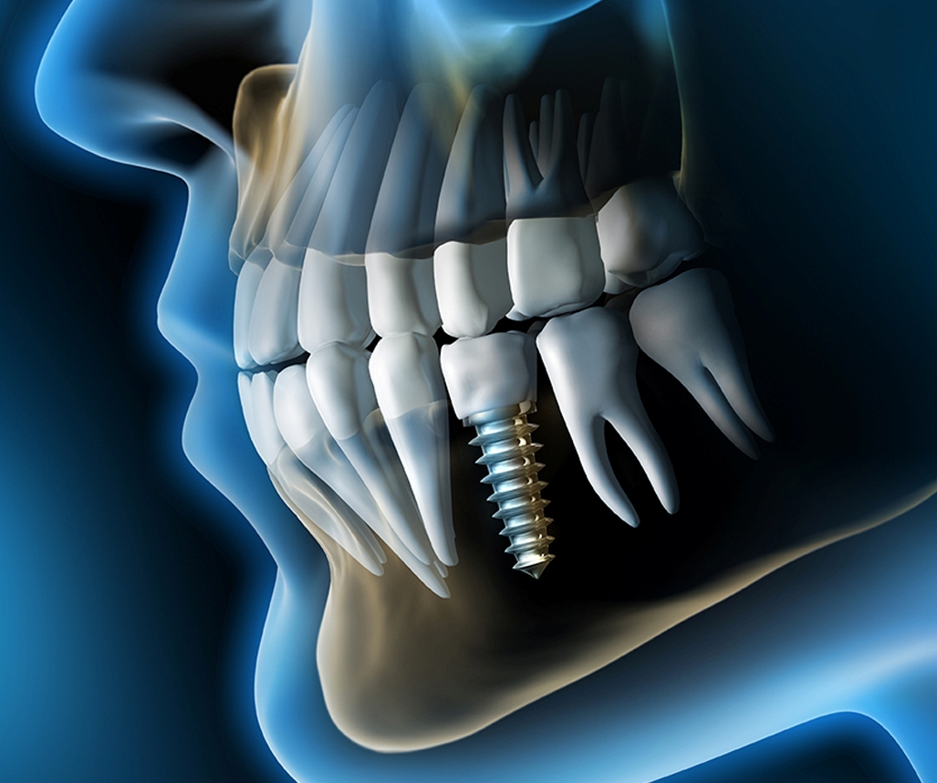 dental implants 2